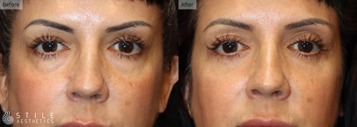 Lower Eyelid Surgery Before & After Gallery - Patient 225704 - Image 1