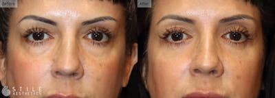 Lower Eyelid Surgery Before & After Gallery - Patient 225704 - Image 1