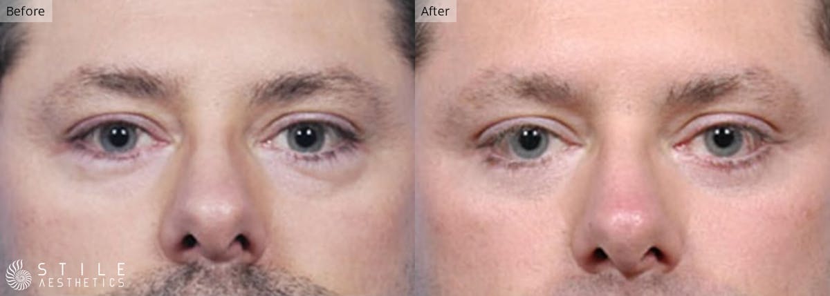 Lower Eyelid Surgery Before & After Gallery - Patient 803407 - Image 1