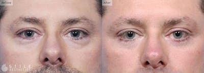 Lower Eyelid Surgery Before & After Gallery - Patient 803407 - Image 1