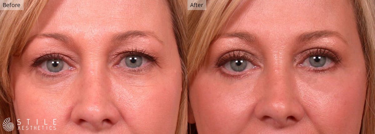 Lower Eyelid Surgery Before & After Gallery - Patient 446624 - Image 1