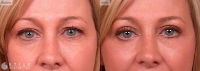 Lower Eyelid Surgery Before & After Gallery - Patient 446624 - Image 1