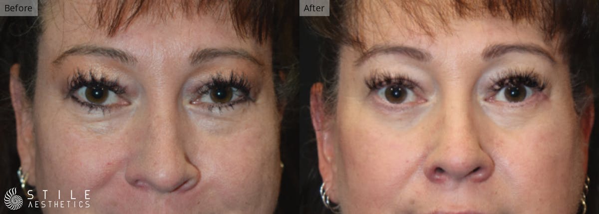 Lower Eyelid Surgery Before & After Gallery - Patient 822847 - Image 1