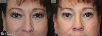 Lower Eyelid Surgery Before & After Gallery - Patient 822847 - Image 1