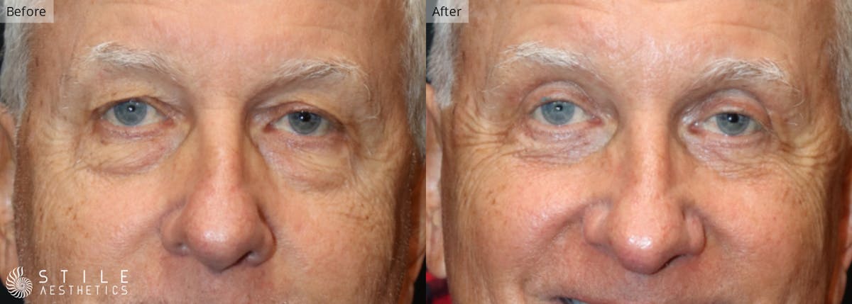 Lower Eyelid Surgery Before & After Gallery - Patient 771480 - Image 1