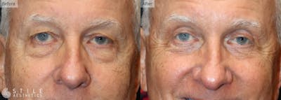 Lower Eyelid Surgery Before & After Gallery - Patient 771480 - Image 1
