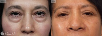 Lower Eyelid Surgery Before & After Gallery - Patient 297662 - Image 1