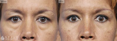 Lower Eyelid Surgery Before & After Gallery - Patient 201833 - Image 1