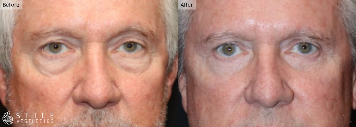 Lower Eyelid Surgery Before & After Gallery - Patient 427090 - Image 1