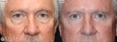 Lower Eyelid Surgery Before & After Gallery - Patient 427090 - Image 1