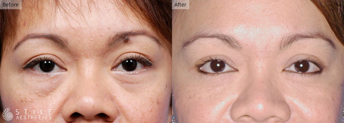 Lower Eyelid Surgery Before & After Gallery - Patient 153392 - Image 1