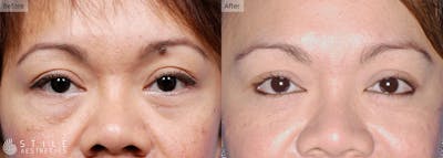 Lower Eyelid Surgery Before & After Gallery - Patient 153392 - Image 1