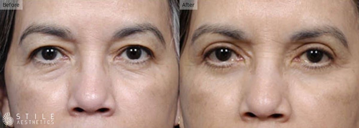 Lower Eyelid Surgery Before & After Gallery - Patient 142087 - Image 1