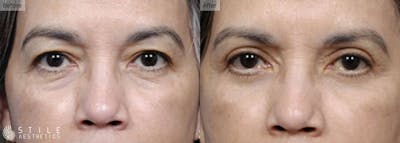Lower Eyelid Surgery Before & After Gallery - Patient 142087 - Image 1