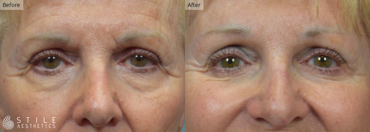 Lower Eyelid Surgery Before & After Gallery - Patient 480529 - Image 1