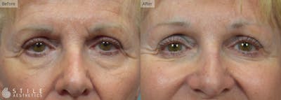 Lower Eyelid Surgery Before & After Gallery - Patient 480529 - Image 1