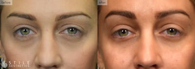 Lower Eyelid Surgery Before & After Gallery - Patient 370530 - Image 1