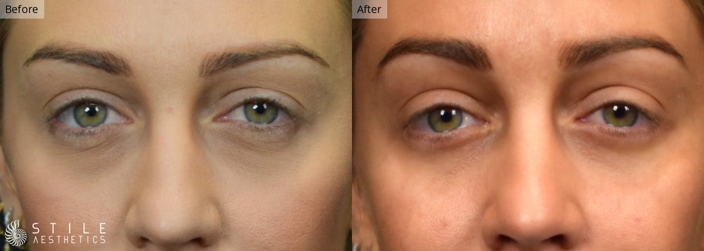 Lower Eyelid Surgery Before & After Gallery - Patient 370530 - Image 1