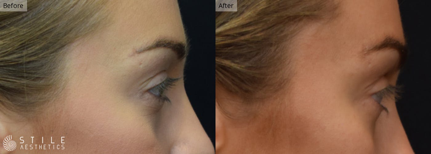 Lower Eyelid Surgery Before & After Gallery - Patient 370530 - Image 2