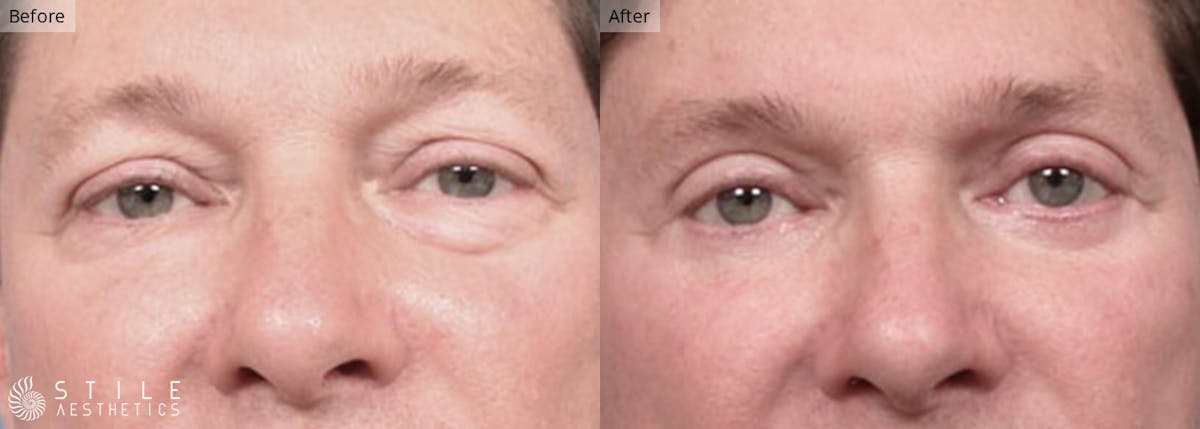 Lower Eyelid Surgery Before & After Gallery - Patient 261866 - Image 1