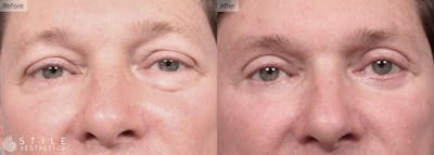 Lower Eyelid Surgery Before & After Gallery - Patient 261866 - Image 1
