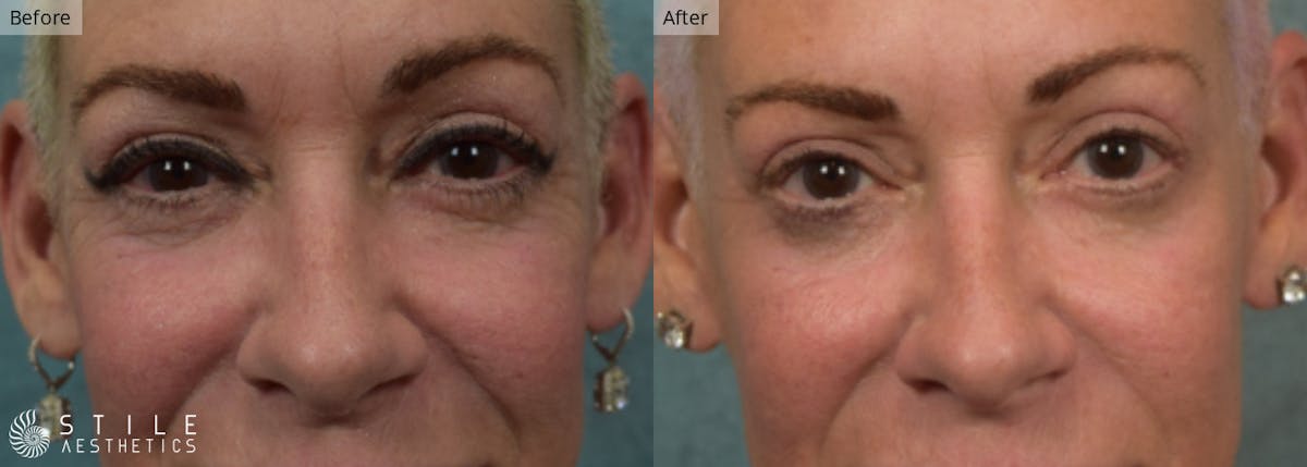 Lower Eyelid Surgery Before & After Gallery - Patient 412741 - Image 1