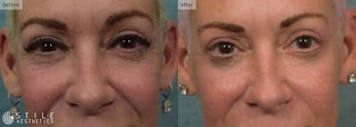 Lower Eyelid Surgery Before & After Gallery - Patient 412741 - Image 1