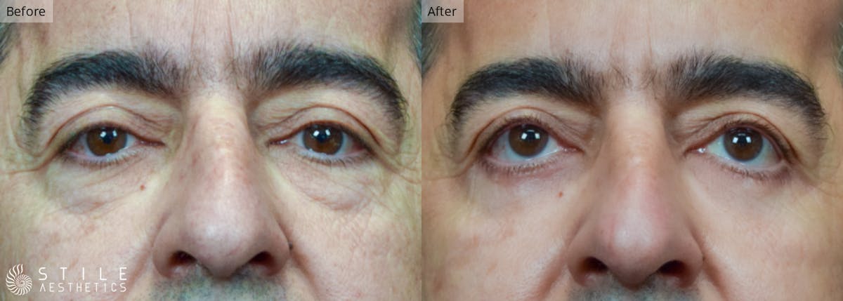 Lower Eyelid Surgery Before & After Gallery - Patient 256360 - Image 1