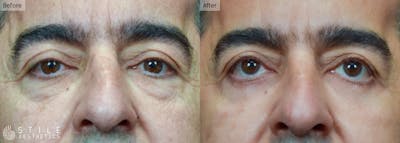 Lower Eyelid Surgery Before & After Gallery - Patient 256360 - Image 1