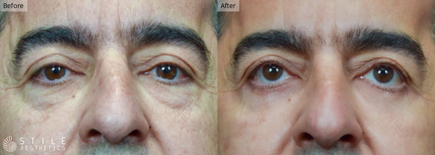 Lower Eyelid Surgery Before & After Gallery - Patient 256360 - Image 1