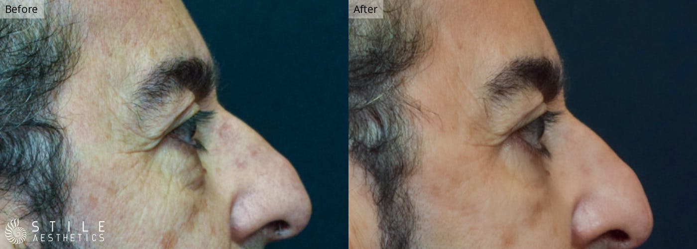 Lower Eyelid Surgery Before & After Gallery - Patient 256360 - Image 2