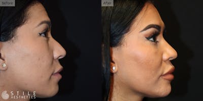 Rhinoplasty Before & After Gallery - Patient 128078 - Image 1