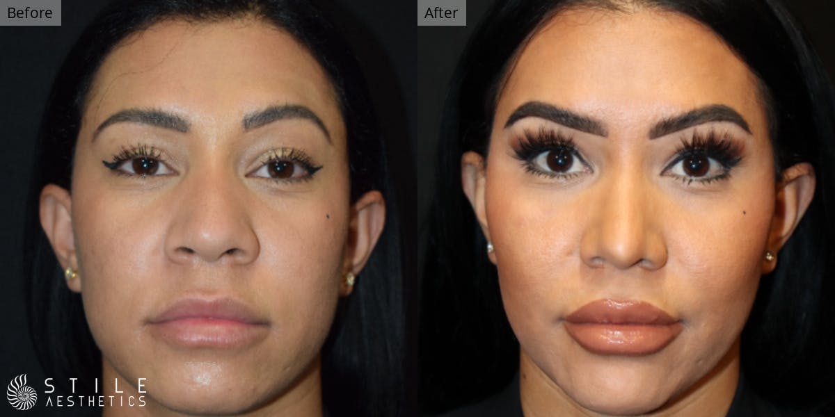 Rhinoplasty Before & After Gallery - Patient 128078 - Image 2