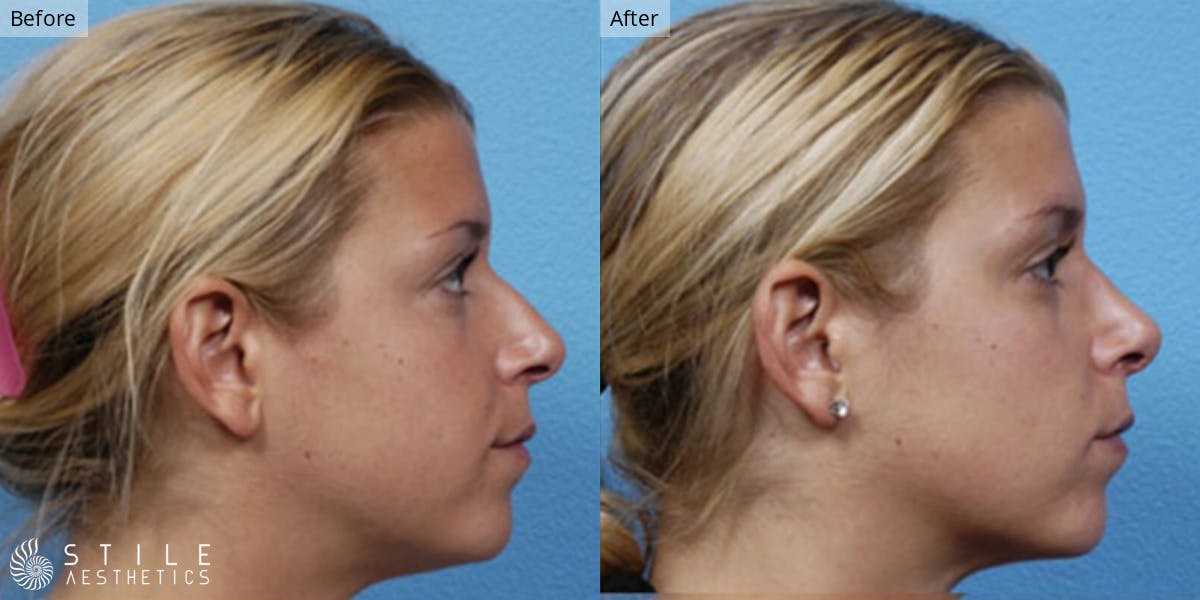Rhinoplasty Before & After Gallery - Patient 149846 - Image 1