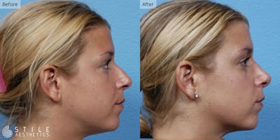 Rhinoplasty Before & After Gallery - Patient 149846 - Image 1