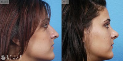 Rhinoplasty Before & After Gallery - Patient 407002 - Image 1