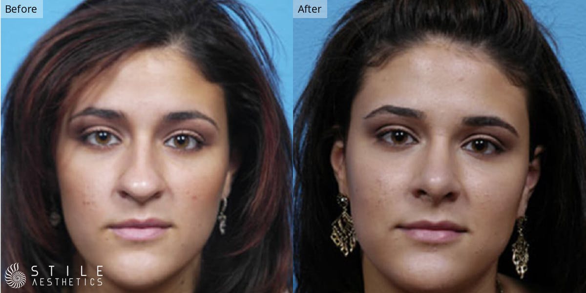 Rhinoplasty Before & After Gallery - Patient 407002 - Image 2