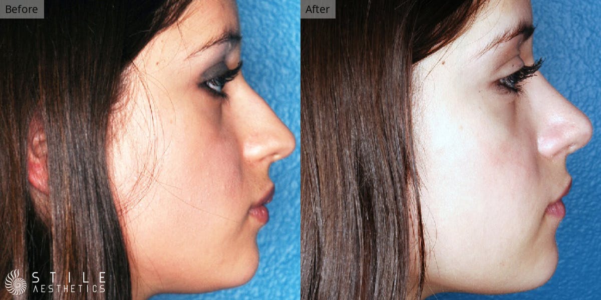 Rhinoplasty Before & After Gallery - Patient 153532 - Image 1