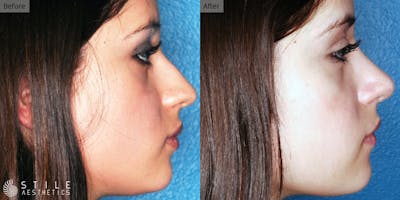 Rhinoplasty Before & After Gallery - Patient 153532 - Image 1