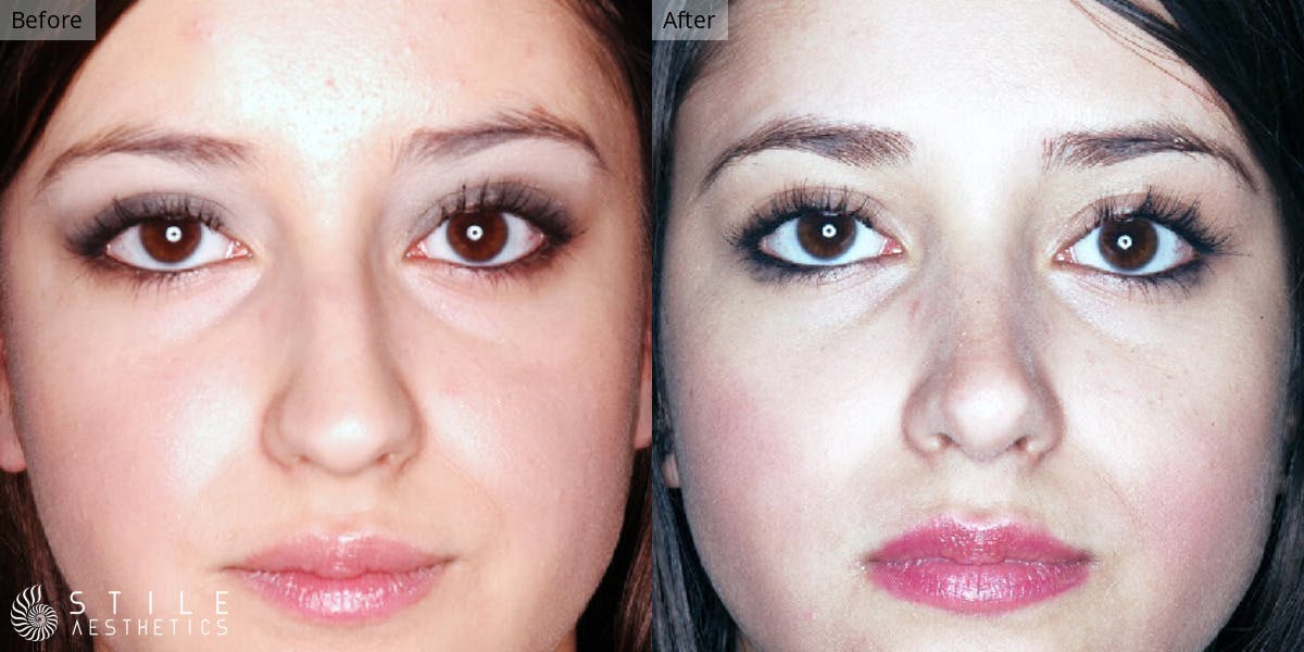 Rhinoplasty Before & After Gallery - Patient 153532 - Image 2