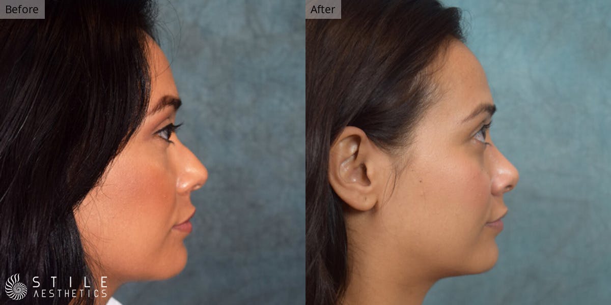 Rhinoplasty Before & After Gallery - Patient 543899 - Image 1