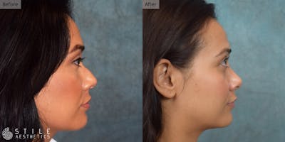 Rhinoplasty Before & After Gallery - Patient 543899 - Image 1