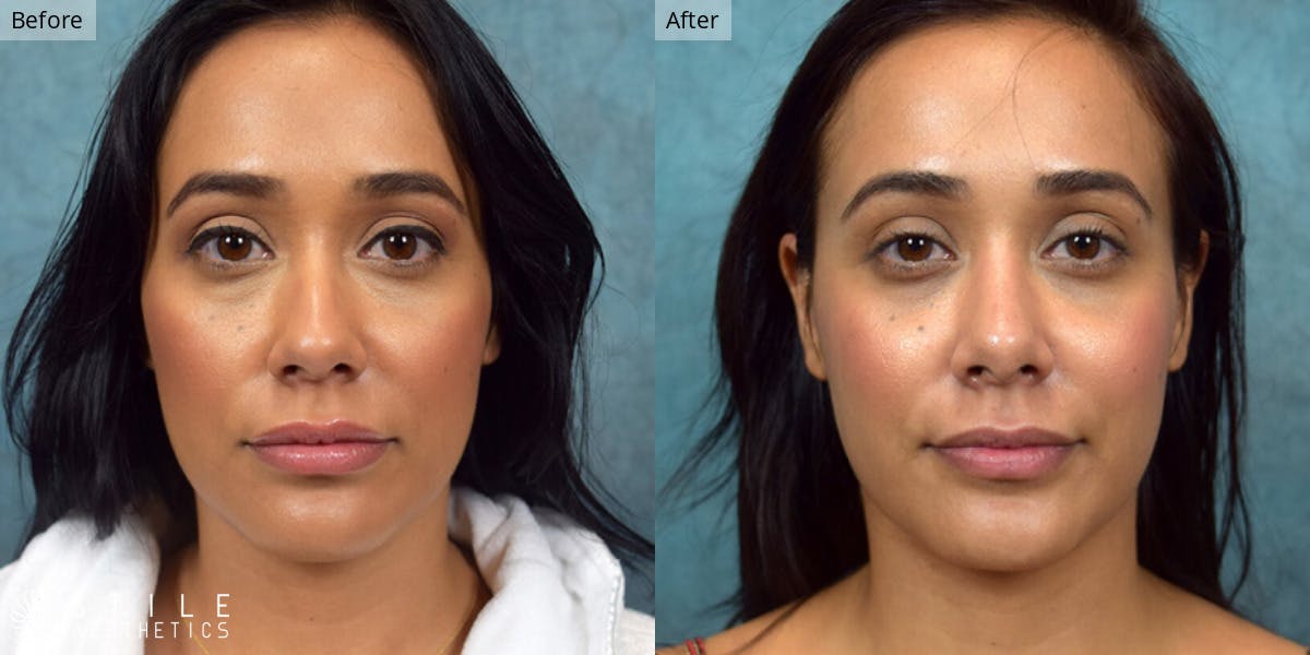 Rhinoplasty Before & After Gallery - Patient 543899 - Image 2