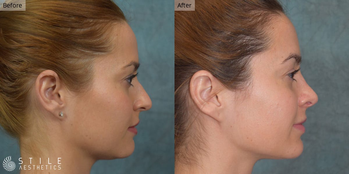 Rhinoplasty Before & After Gallery - Patient 108785 - Image 1