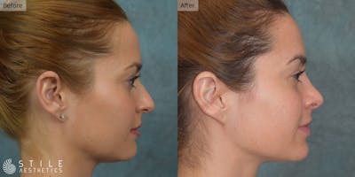 Rhinoplasty Before & After Gallery - Patient 108785 - Image 1