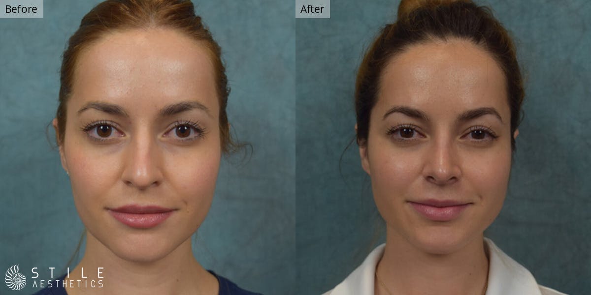 Rhinoplasty Before & After Gallery - Patient 108785 - Image 2