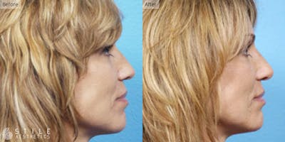Rhinoplasty Before & After Gallery - Patient 139174 - Image 1
