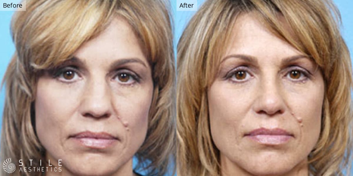 Rhinoplasty Before & After Gallery - Patient 139174 - Image 2