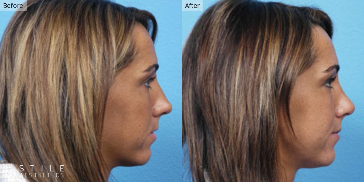 Rhinoplasty Before & After Gallery - Patient 122539 - Image 1