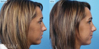 Rhinoplasty Before & After Gallery - Patient 122539 - Image 1